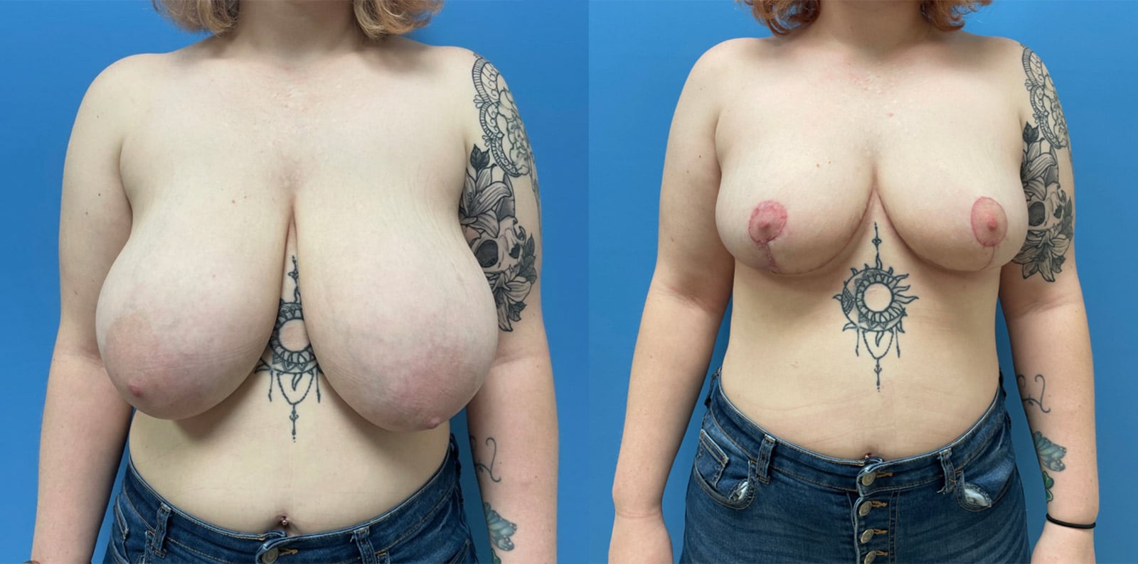 breast-reduction2