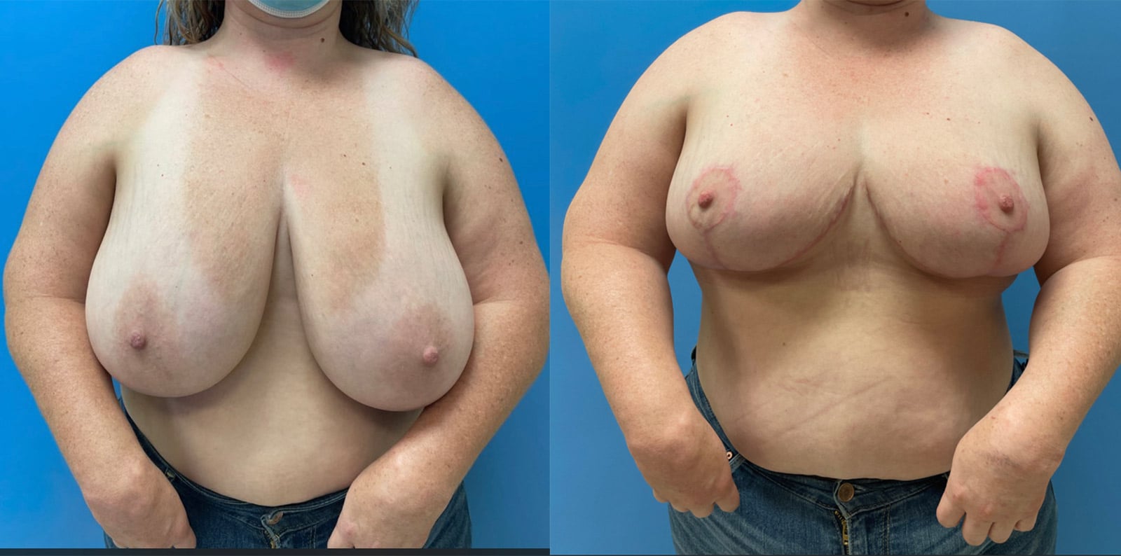 breast-reduction3
