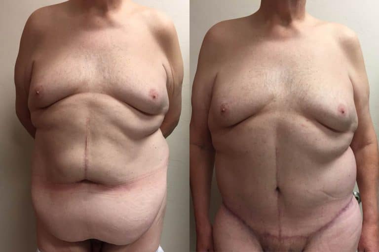 Best-lower-body-lift-surgeon-tucson-Hess-Sandeen-before-after4-768x512