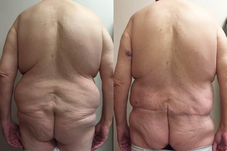 Best-lower-body-lift-surgeon-tucson-Hess-Sandeen-before-after6-768x512