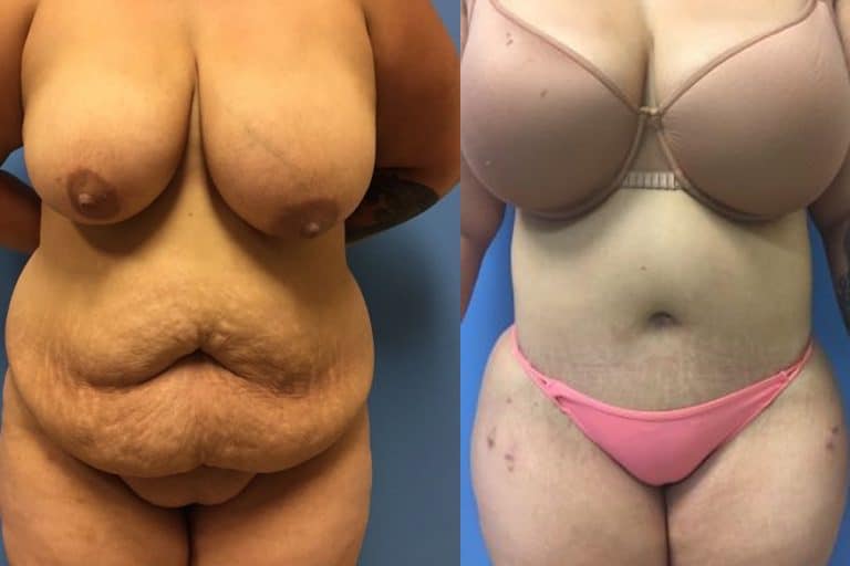Best-total-body-lift-surgeon-tucson-Hess-Sandeen-before-after-768x512
