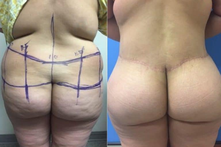 Best-total-body-lift-surgeon-tucson-Hess-Sandeen-before-after1-768x512