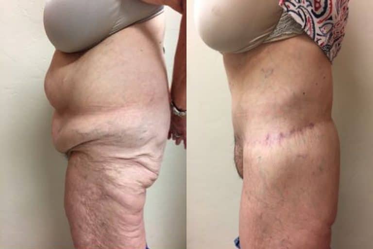 Best-total-body-lift-surgeon-tucson-Hess-Sandeen-before-after2-768x512