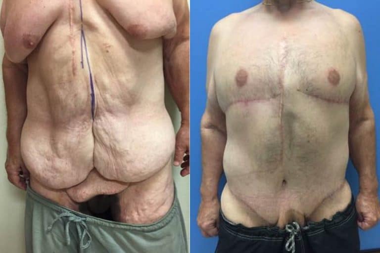 Best-upper-body-and-lower-body-lift-surgeon-tucson-Hess-Sandeen-before-after-768x512
