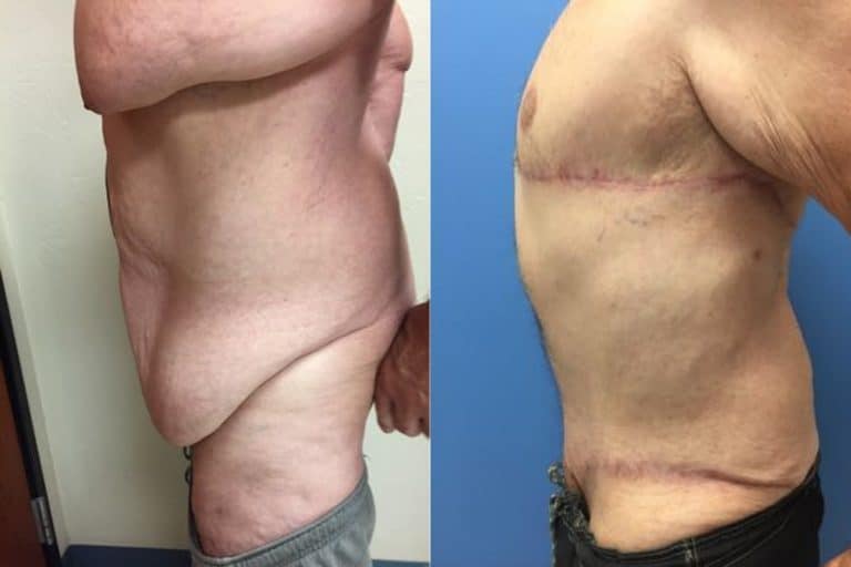 Best-upper-body-lift-and-lower-body-lift-surgeon-tucson-Hess-Sandeen-before-after1-768x512