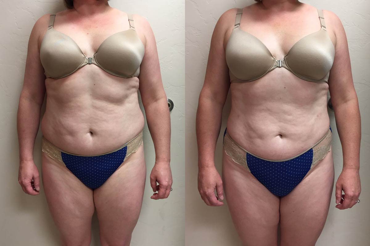 Hess-Sandeen-tumescent-liposuction-arizona-before-after3