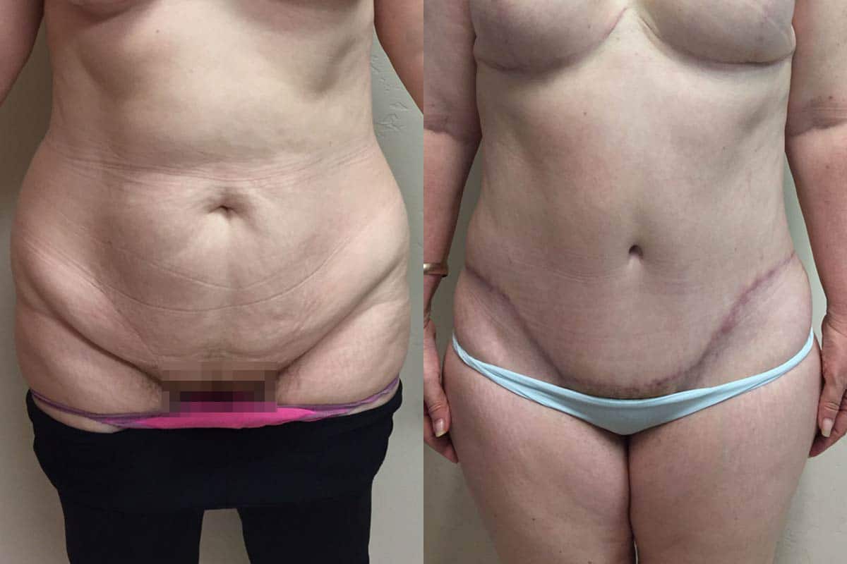 Hess-Sandeen-tummy-tuck-surgery-tucson-before-after1