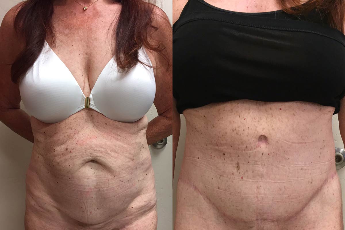 Hess-Sandeen-tummy-tuck-surgery-tucson-before-after11