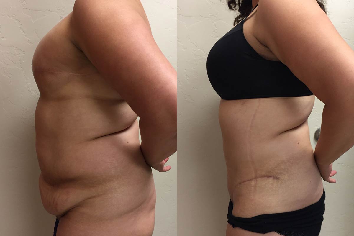 Hess-Sandeen-tummy-tuck-surgery-tucson-before-after14