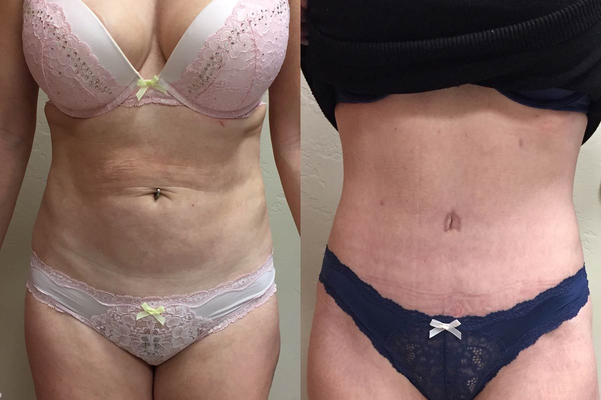 Hess-Sandeen-tummy-tuck-surgery-tucson-before-after6