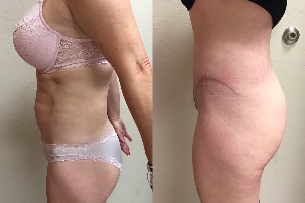 Hess-Sandeen-tummy-tuck-surgery-tucson-before-after7