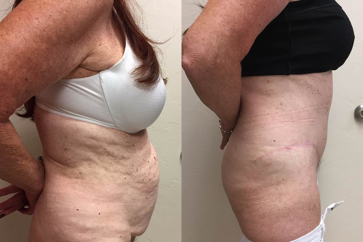 Hess-Sandeen-tummy-tuck-surgery-tucson-before-after9