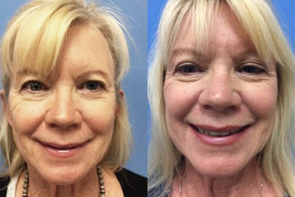 Hess-Sandeen-Facelift-Tucson-before-after13-1024x683