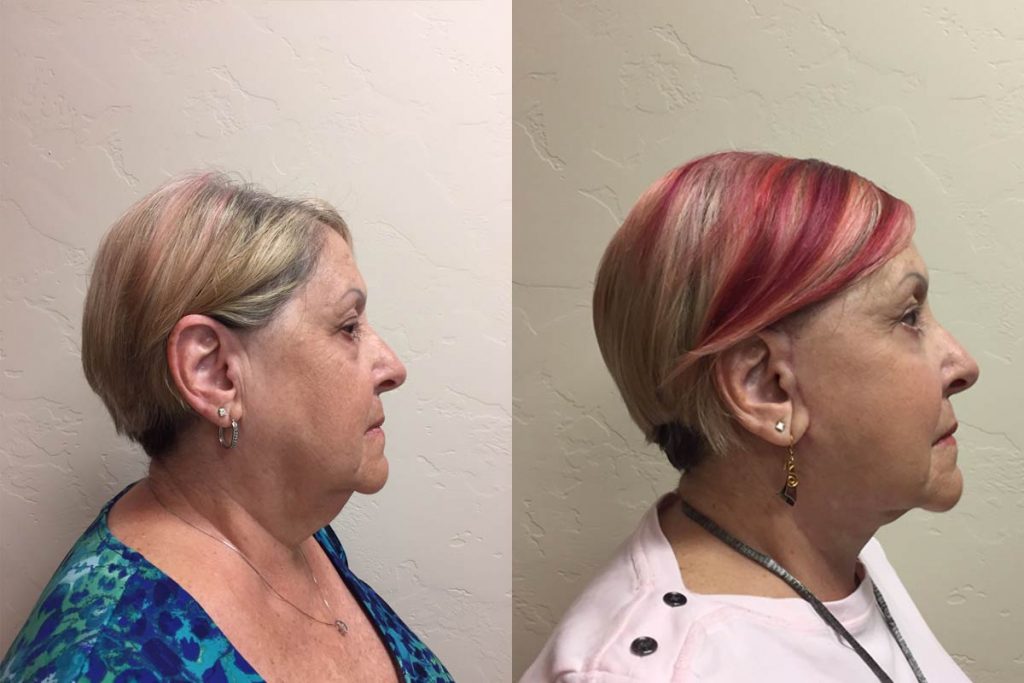 Hess-Sandeen-Facelift-Tucson-before-after8-1024x683