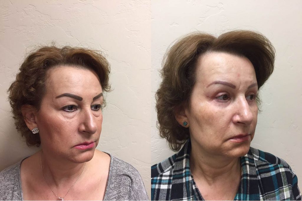 Hess-Sandeen-eyelid-surgery-in-tucson-before-after1-1024x683