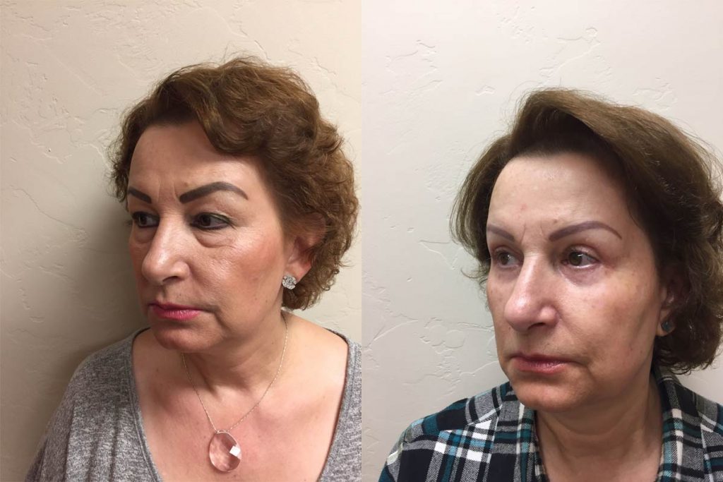 Hess-Sandeen-eyelid-surgery-tucson-before-after-1024x683