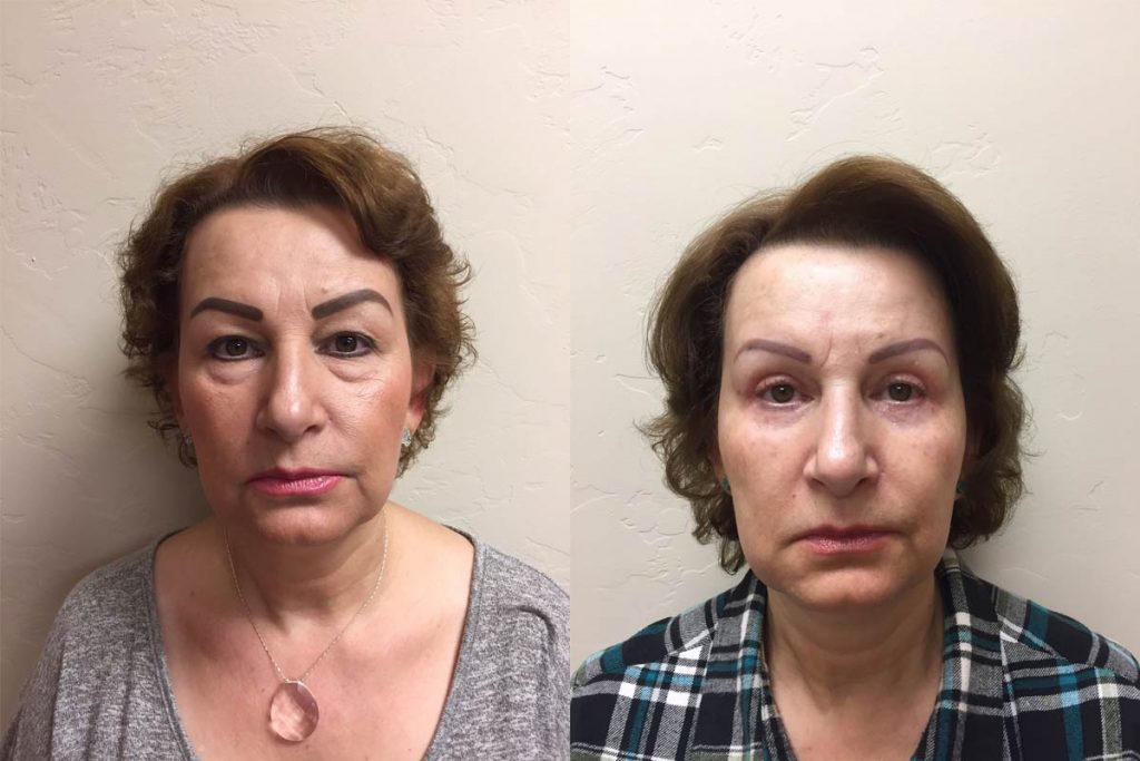 Hess-Sandeen-eyelid-surgery-tucson-before-after2-1024x683